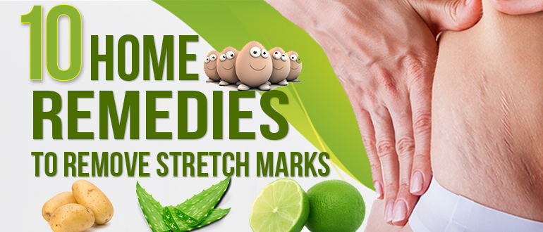 How to Get Rid of Stretch Marks -10 Home Remedies to ...