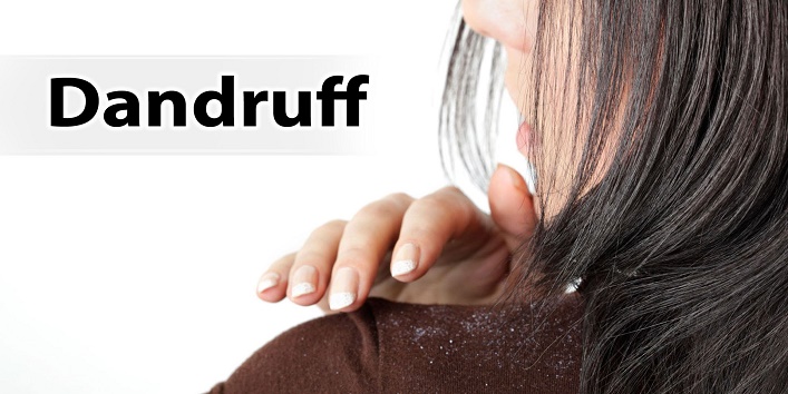  You have dandruff