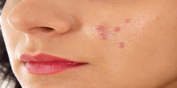 Treat acne scars and pimples